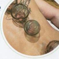 Cupping
